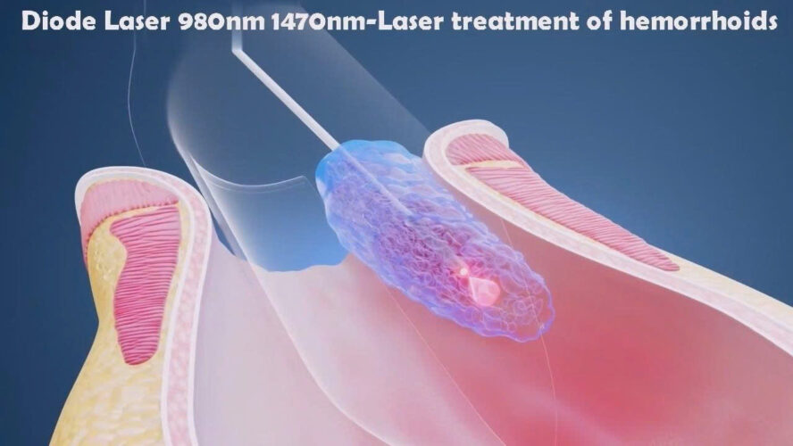 Máy Laser Điều Trị Bệnh Trĩ Dimed